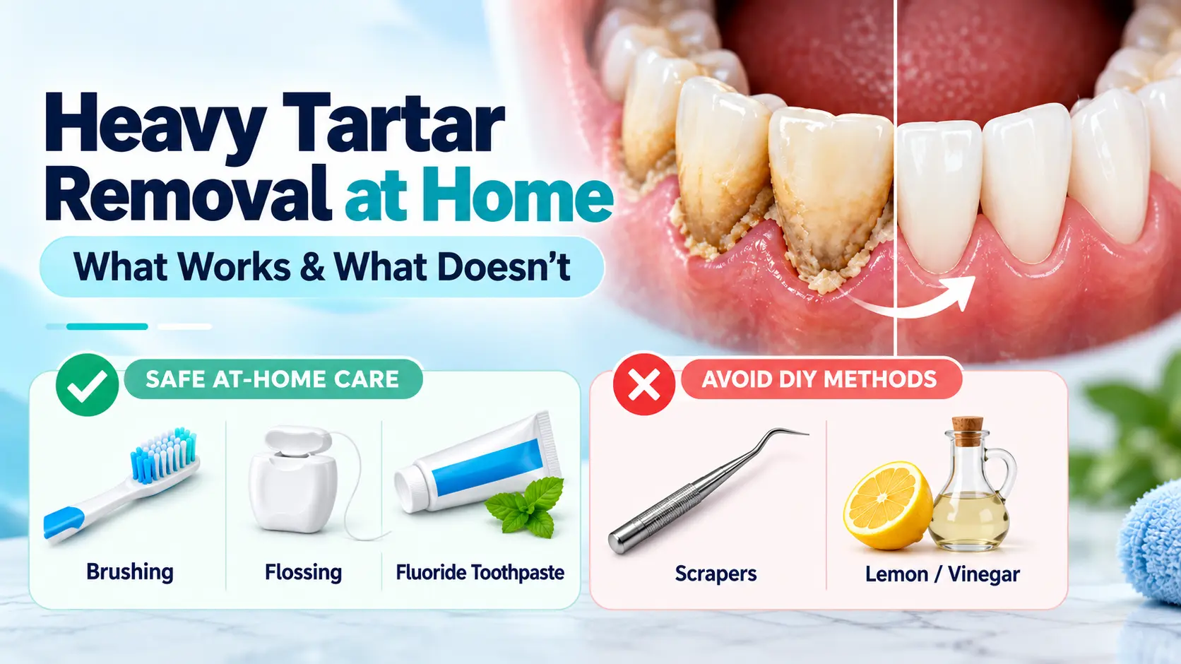 Heavy Tartar Removal at Home